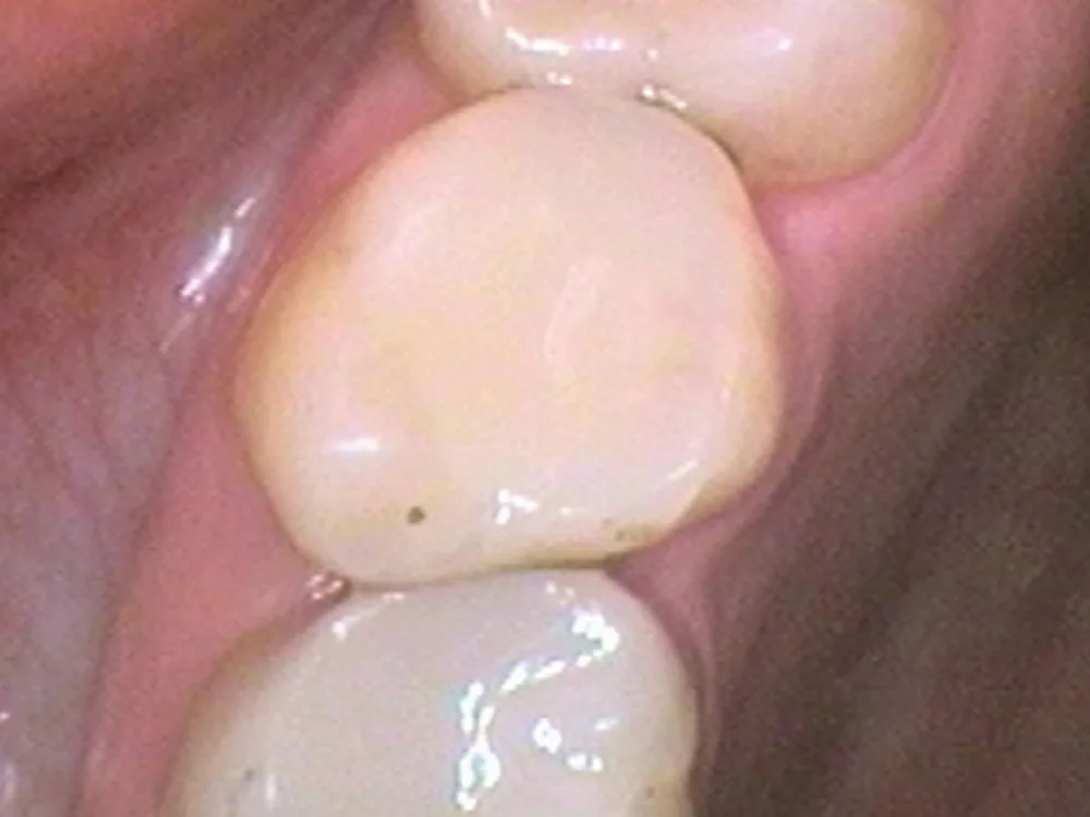 composite 3 case 3 after