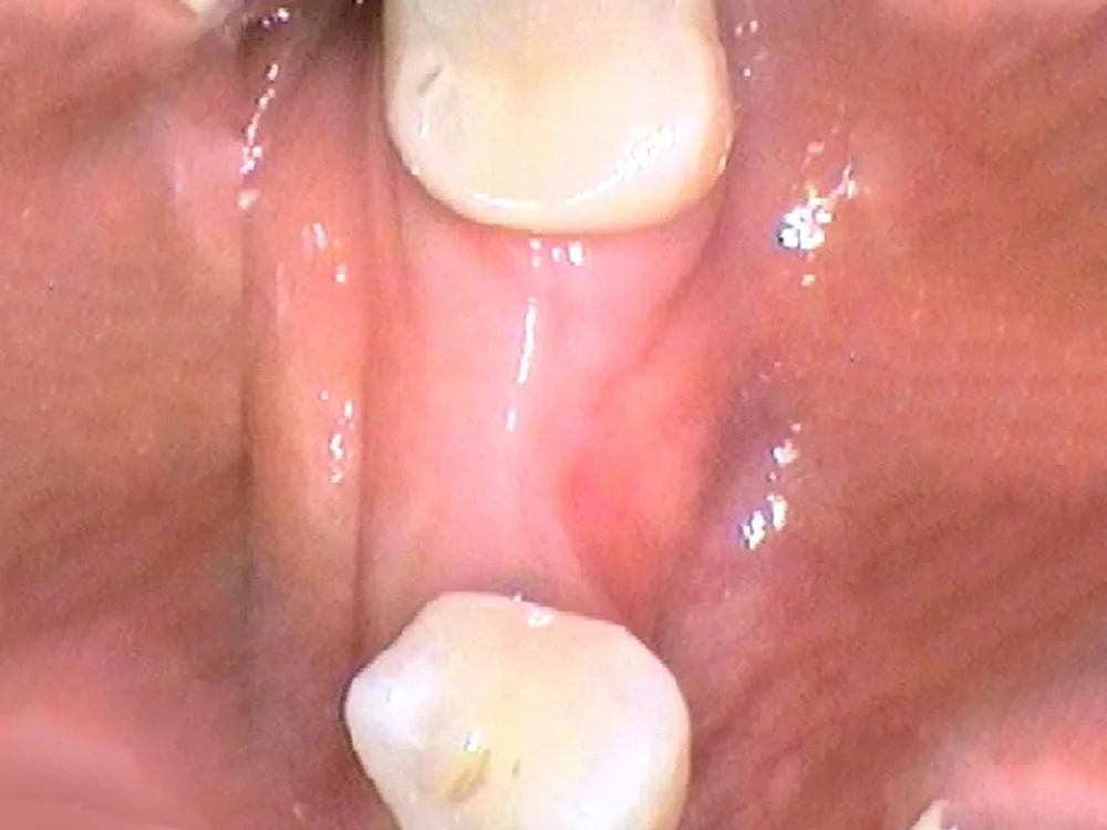 implant before 1
