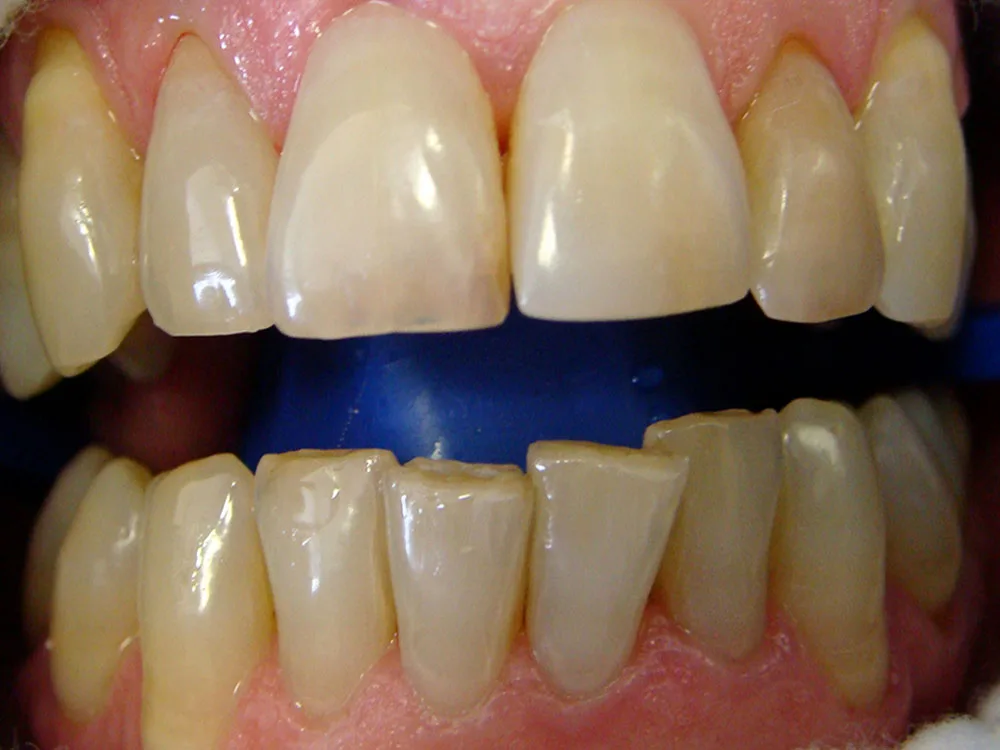 teeth whitening before jpg