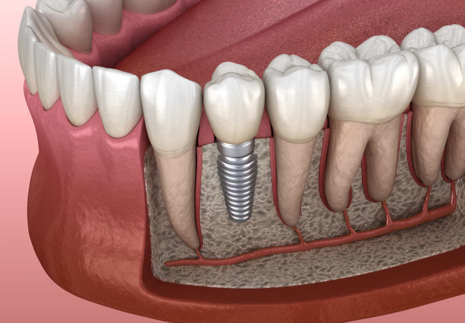 Dentist explaining a dental implant used to replace a missing tooth at a Dee Why clinic